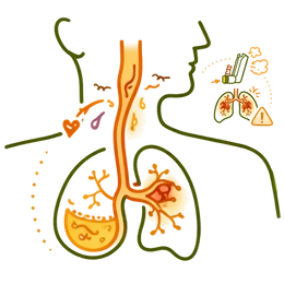 A medical infographic illustrating the asthma risk & complications of acidity, showing stomach acid refluxing into the esophagus and entering the lungs, causing bronchial inflammation and respiratory distress.