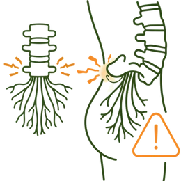 Diagram showing severe compression of the nerve roots at the base of the spinal cord indicating Cauda Equina Syndrome.