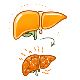 A medical illustration showing the progression from a healthy liver to cirrhosis, highlighting the severe risks & complications of untreated fatty liver disease and permanent tissue scarring.