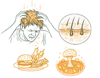 Illustration showing how poor diet and fungal infections contribute to dandruff and scalp issues.