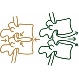 Illustration comparing a compressed spinal disc pressing on a nerve versus a decompressed healthy disc space.