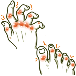 Illustration showing joint deformity in fingers and toes as a long term risk of untreated rheumatoid arthritis.