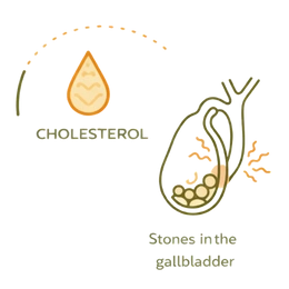 A medical infographic illustrating the formation of Gallstones in the gallbladder, highlighting the significant Gallstones Risks & Complications of High Cholesterol.