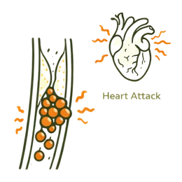 A medical infographic illustrating how plaque buildup in an artery leads to a heart attack, representing the critical Heart Attack Risks & Complications of High Cholesterol.