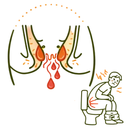 A medical illustration showing hemorrhoids and piles as significant Risk Factors for Constipation, featuring an anatomical view of inflamed rectal veins and a person experiencing painful straining during elimination.