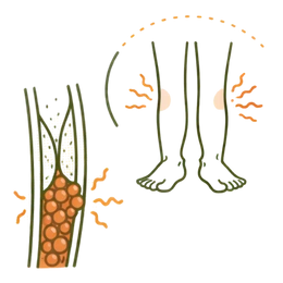 A medical infographic illustrating Peripheral Risks & Complications of High Cholesterol, showing plaque buildup in leg arteries leading to poor circulation and discomfort.