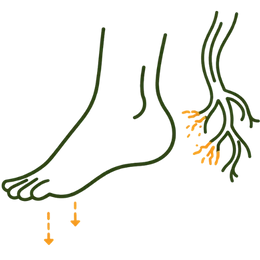 Icon illustrating nerve degeneration and loss of sensation in the foot due to untreated chronic nerve compression.