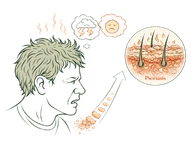 Mental stress and anxiety acting as psychological triggers for psoriasis and eczema flare-ups.