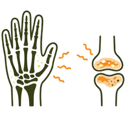 Illustration of joint inflammation and bone health risks like psoriatic arthritis.
