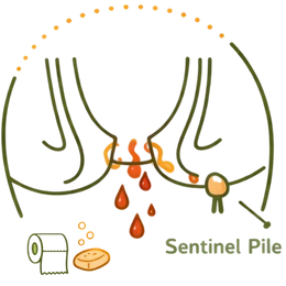 A medical illustration showing a Sentinel Pile (skin tag) at the edge of an anal fissure, highlighting the chronic Risks & Complications of Untreated Piles & Fissures.